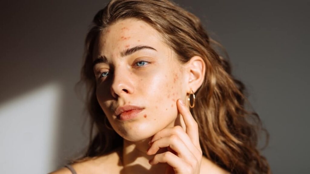 Dermatologists share how anxiety and stress trigger breakouts, hair loss and ageing: ‘It worsens skin conditions’ | Health